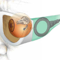 Retinal-Implant-System
